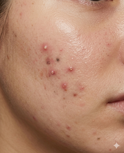 Acne & Breakouts